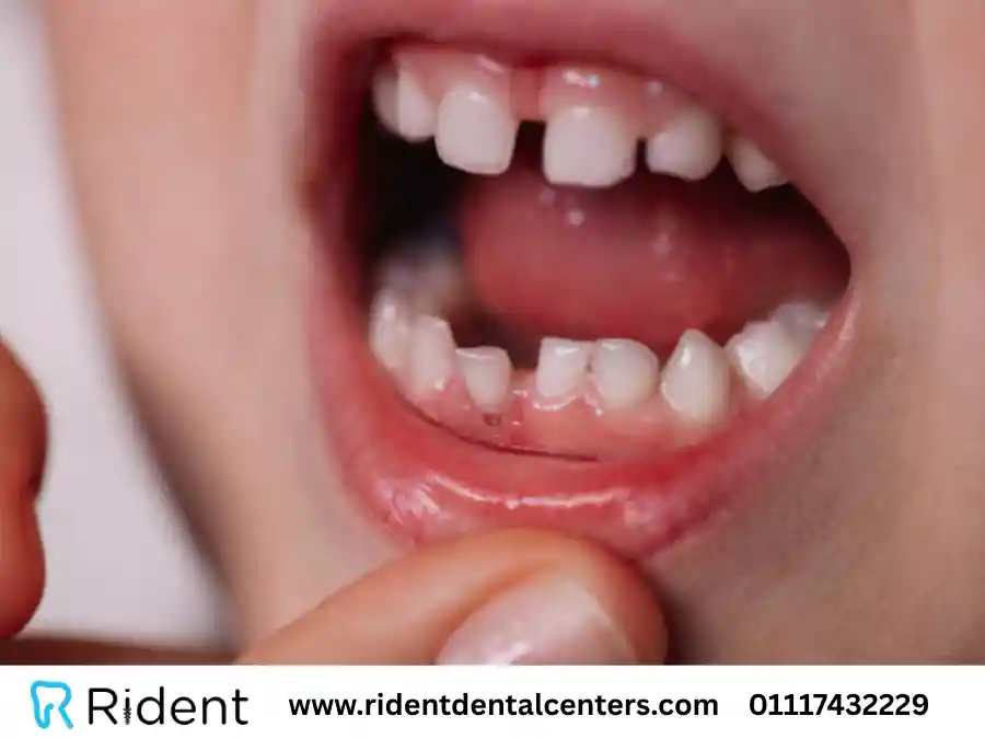 9 تساؤلات عن الاسنان اللبنية تهم كل أم